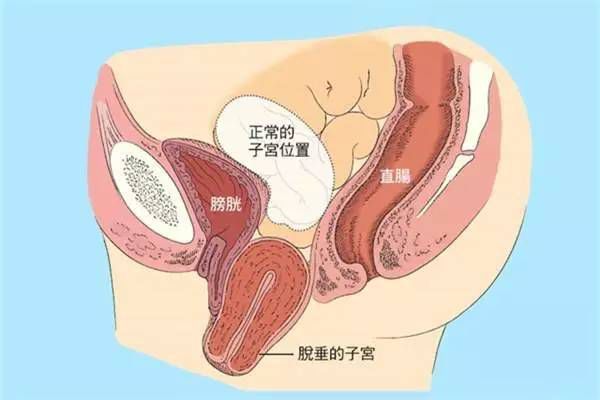 【產(chǎn)后修復(fù)】盆腔臟器脫垂，你有嗎？