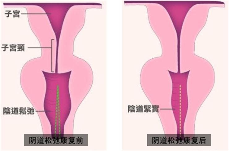 【盆底肌修復】盆底不修復，老來后患無窮