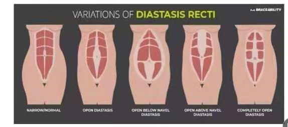 腹直肌分離如何分類(lèi)？腹直肌分離修復(fù)