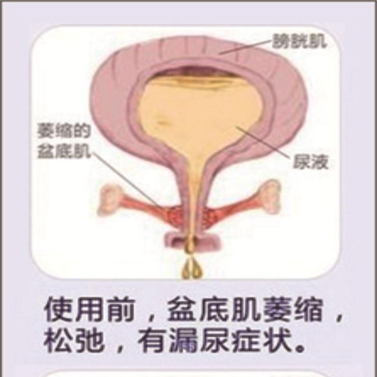 產(chǎn)后盆底肌康復(fù)|“社交癌”盯上你了嗎？