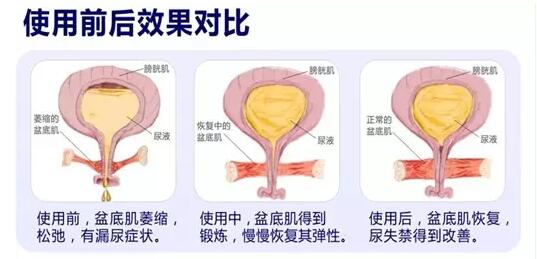 盆底康復(fù)治療怎么做？產(chǎn)后盆底功能檢測(cè)很重要