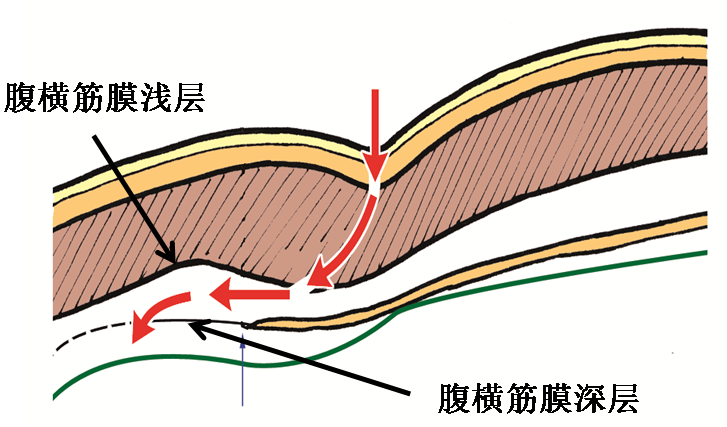 產(chǎn)后腹直肌分離如何康復(fù)，腹直肌修復(fù)那點(diǎn)事