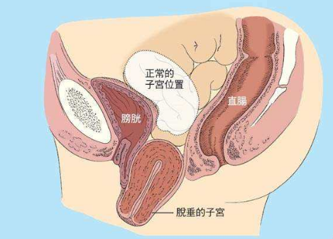 人們常說，產(chǎn)后女性做好盆底肌修復(fù)是關(guān)鍵，但盆腔器官的脫垂你也得注意