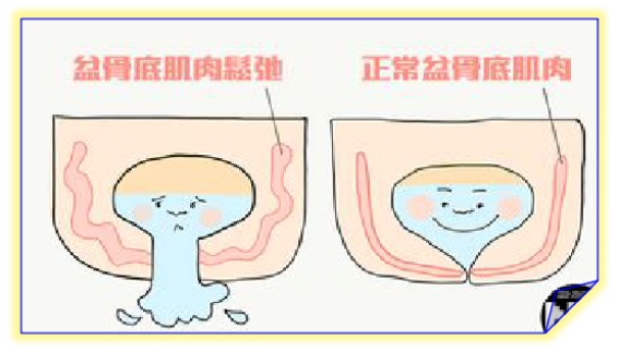 盆底康復(fù)治療怎么做，盆底肌修復(fù)常見的十大問題（中）