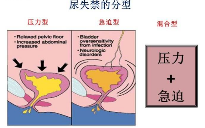 產(chǎn)后盆底肌怎么修復(fù)|尿失禁的類型，傻傻分不清