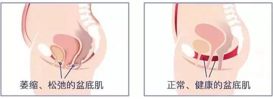 尿失禁治療儀器，不再詢問盆底康復(fù)治療有用嗎這類無意義問題