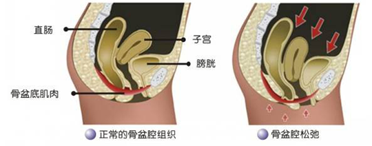 盆底功能檢測很重要，盆底肌松弛了會有什么表現(xiàn)呢？