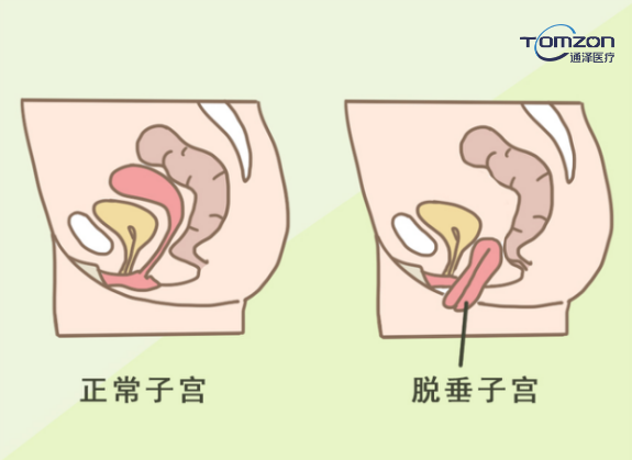 你害怕子宮脫垂嗎？盆底肌修復儀器來(lái)拯救你