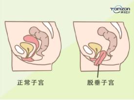 盆底肌修復儀器用對地方治療很有效