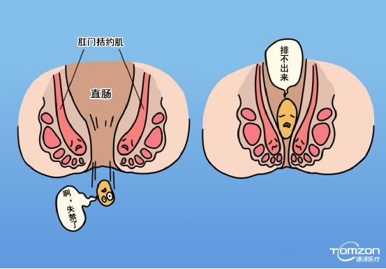 便秘跟盆底肌有什么關(guān)系，能用盆底肌修復(fù)儀器治療嗎？