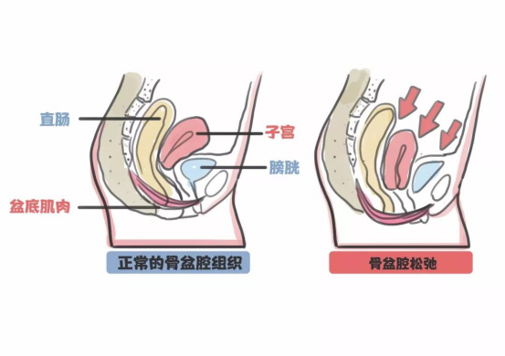 骨盆修復