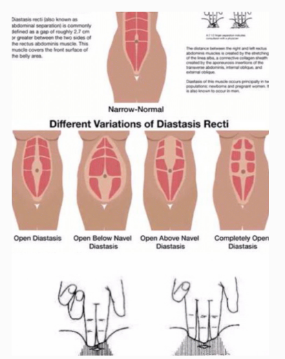產(chǎn)后腹直肌分離