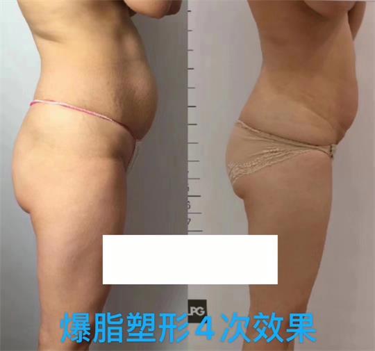 產(chǎn)后塑形美雕儀，生完孩子真的很難恢復(fù)身材？未必……