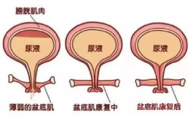 尿頻尿急尿不盡？或者可以試試盆底肌修復(fù)儀器電刺激