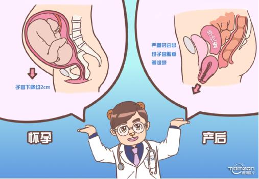 盆底康復(fù)治療儀可以解決子宮下降問題嗎？