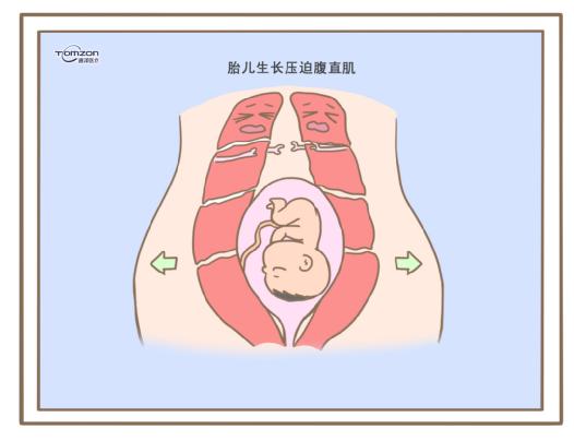 腹直肌分離可以使用盆底肌修復(fù)儀器嗎？