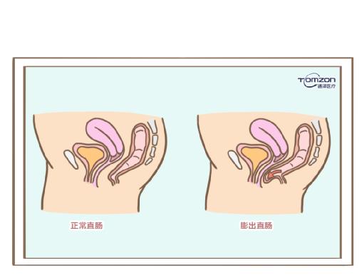 盆底肌修復儀器.jpg