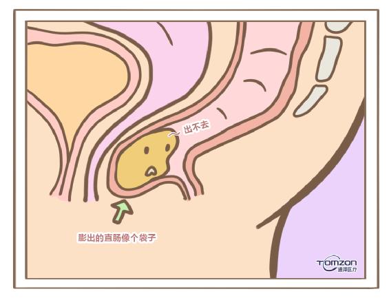 盆底康復治療儀